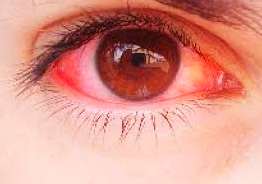 alergia-ocular-001