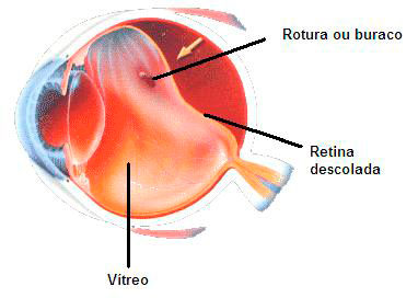 deslocamento-retina-001